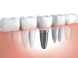 Why Are Dental Implants Key To A Functional And Beautiful Smile?