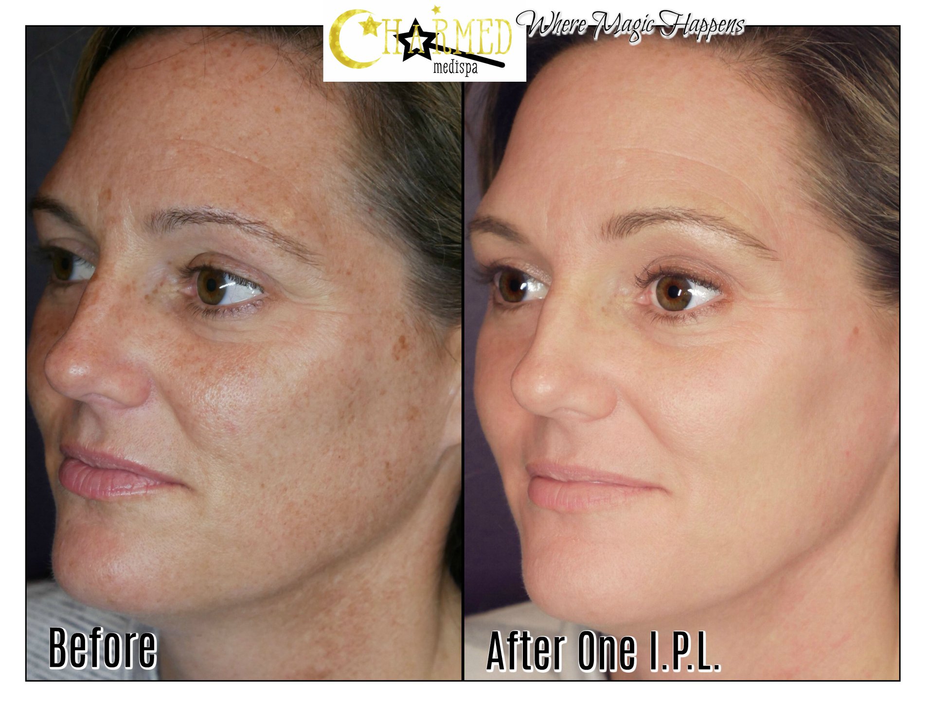 IPL Face Treatment Unveiling the Magic of Skin Rejuvenation