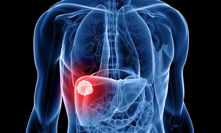 Common Signs and Symptoms of Liver Cancer