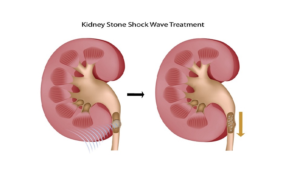 Breaking Kidney Stones with Shockwave Lithotripsy