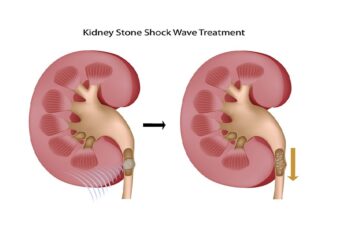 Breaking Kidney Stones with Shockwave Lithotripsy