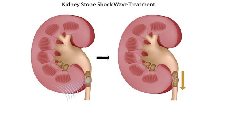 Breaking Kidney Stones with Shockwave Lithotripsy