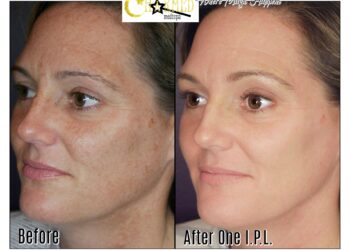 IPL Face Treatment Unveiling the Magic of Skin Rejuvenation