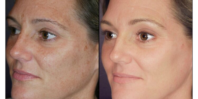 IPL Face Treatment Unveiling the Magic of Skin Rejuvenation